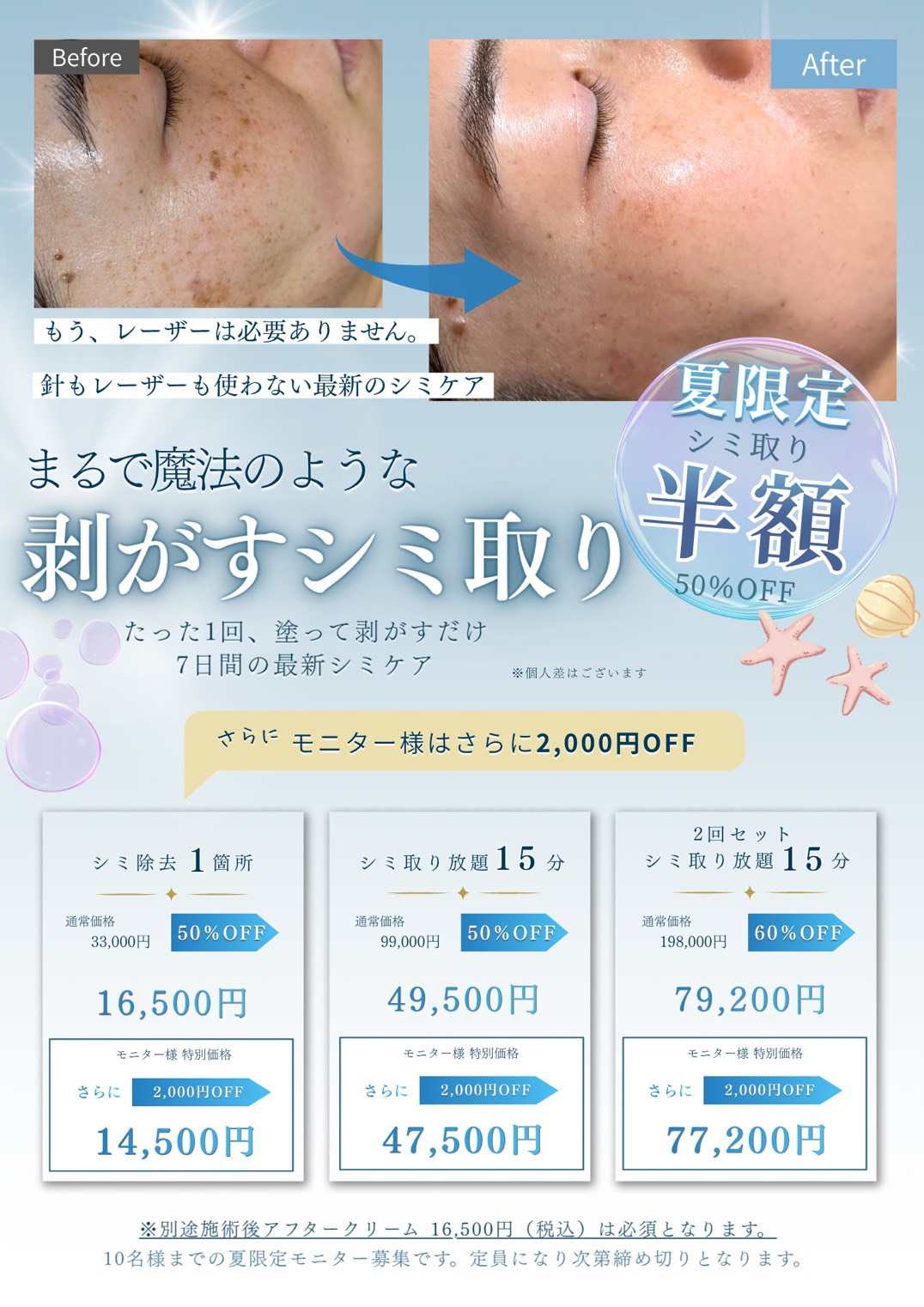 夏限定！！シミ取り半額キャンペーン！