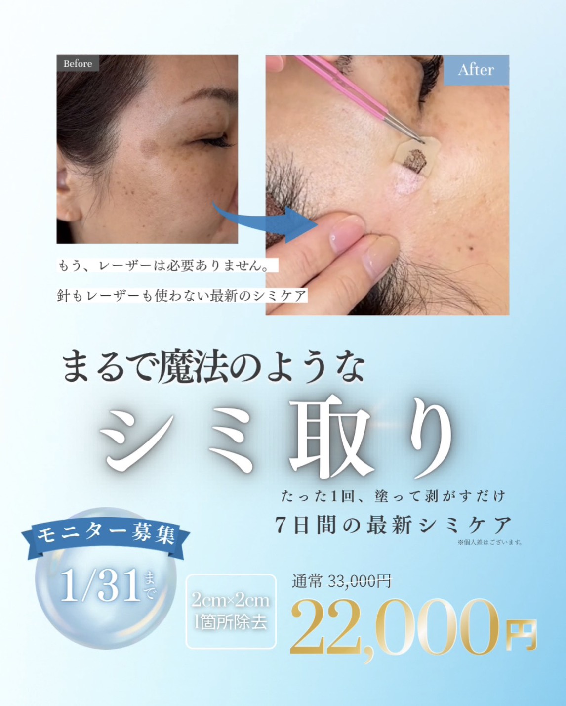 シミ取りのモニター募集